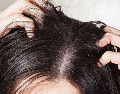 Anti Dandruff Treatment